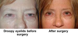 Picture of patient before and after eyelid surgery