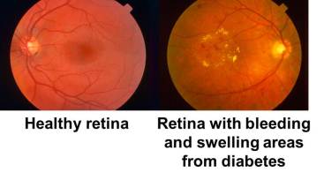 diabetic retinopathy