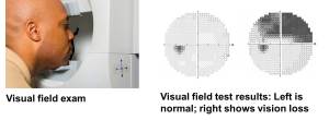 Picture of visual field test and result